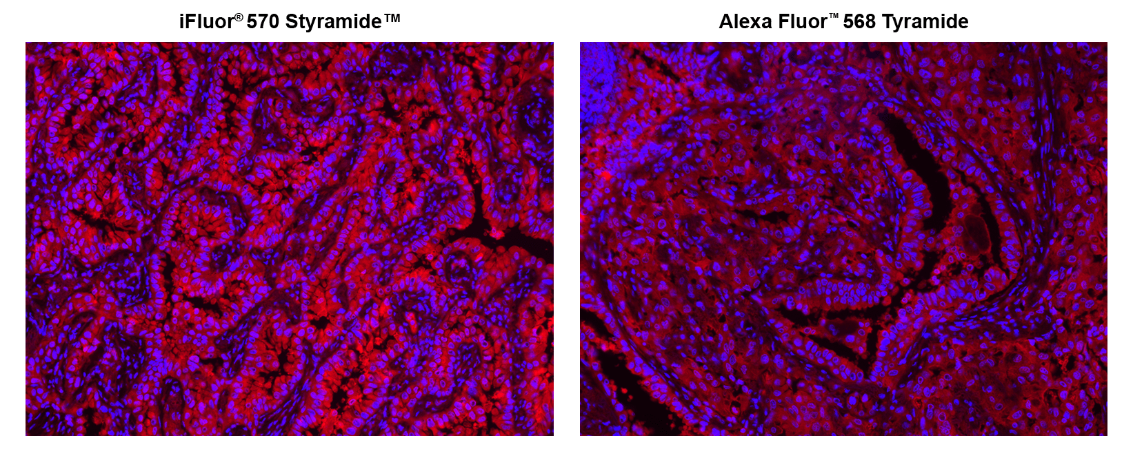 Fluorescence IHC was performed on formaldehyde-fixed, paraffin-embedded human lung adenocarcinoma-positive tissue using PSA™ and TSA amplified methods. First, the tissue sections were stained with rabbit anti-EpCam antibody and then incubated with polyHRP-labeled Goat anti-Rabbit IgG secondary antibody. The signal was developed using either iFluor® 570 Styramide™ (Cat No. 45031) or Alexa Fluor® 568 tyramide stain, respectively, and detected with a Cy3/TRITC filter set. Finally, the nuclei (blue) were counterstained with DAPI (Cat No. 17507).