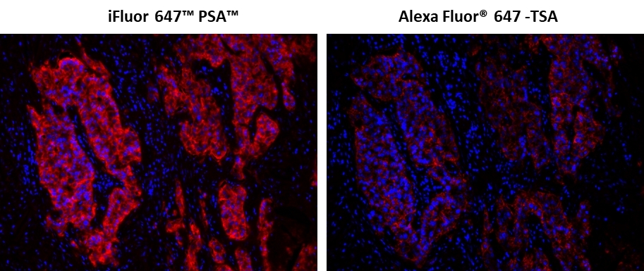 Fluorescence IHC of formaldehyde-fixed, paraffin-embedded using PSA<strong> &trade; </strong>&nbsp;and TSA amplified methods. Human lung adenocarcinoma positive tissue sections were stained with mouse anti-EpCam antibody and then followed by PSA&trade; method using iFluor 647&trade; PSA&trade; Imaging Kit with Goat Anti-Mouse IgG (Cat#45290) or TSA method using&nbsp; Alexa Fluor&reg; 647 tyramide&nbsp; respectively.&nbsp; Images showed that PSA&trade; super signal amplification can increase the sensitivity of fluorescence IHC over Alexa Fluor&reg; 647 TSA method. Cell nucleus were stained with Nuclear Blue&trade; DCS1 (Cat#17548).