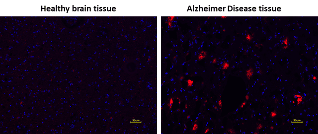 Amylite™ Red staining on healthy and Alzheimer's disease brain tissue with DAPI counterstain.