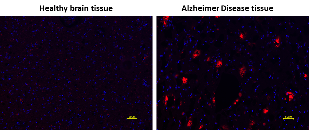 Amylite™ Red staining on healthy and Alzheimer's disease brain tissue with DAPI counterstain.