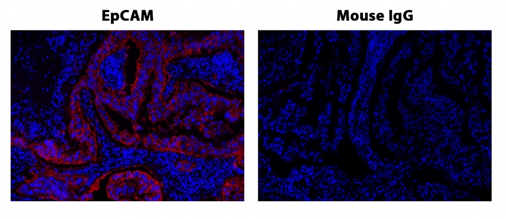 Fluorescence IHC of formaldehyde-fixed, paraffin-embedded human lung adenocarcinoma positive tissue using PSA<strong> ™</strong> amplified methods. Human lung adenocarcinoma positive tissue sections were stained with Mouse anti-EpCAM or Control Mouse IgG antibody and then incubated with polyHRP-labeled Goat anti-Mouse IgG secondary antibody followed by XFD 532 tyramide (Cat#11072).